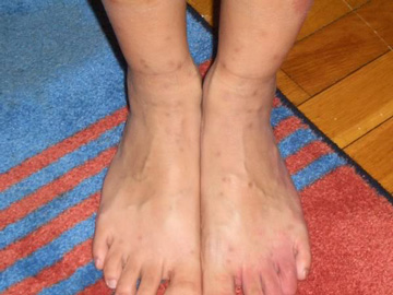 Flea Bites